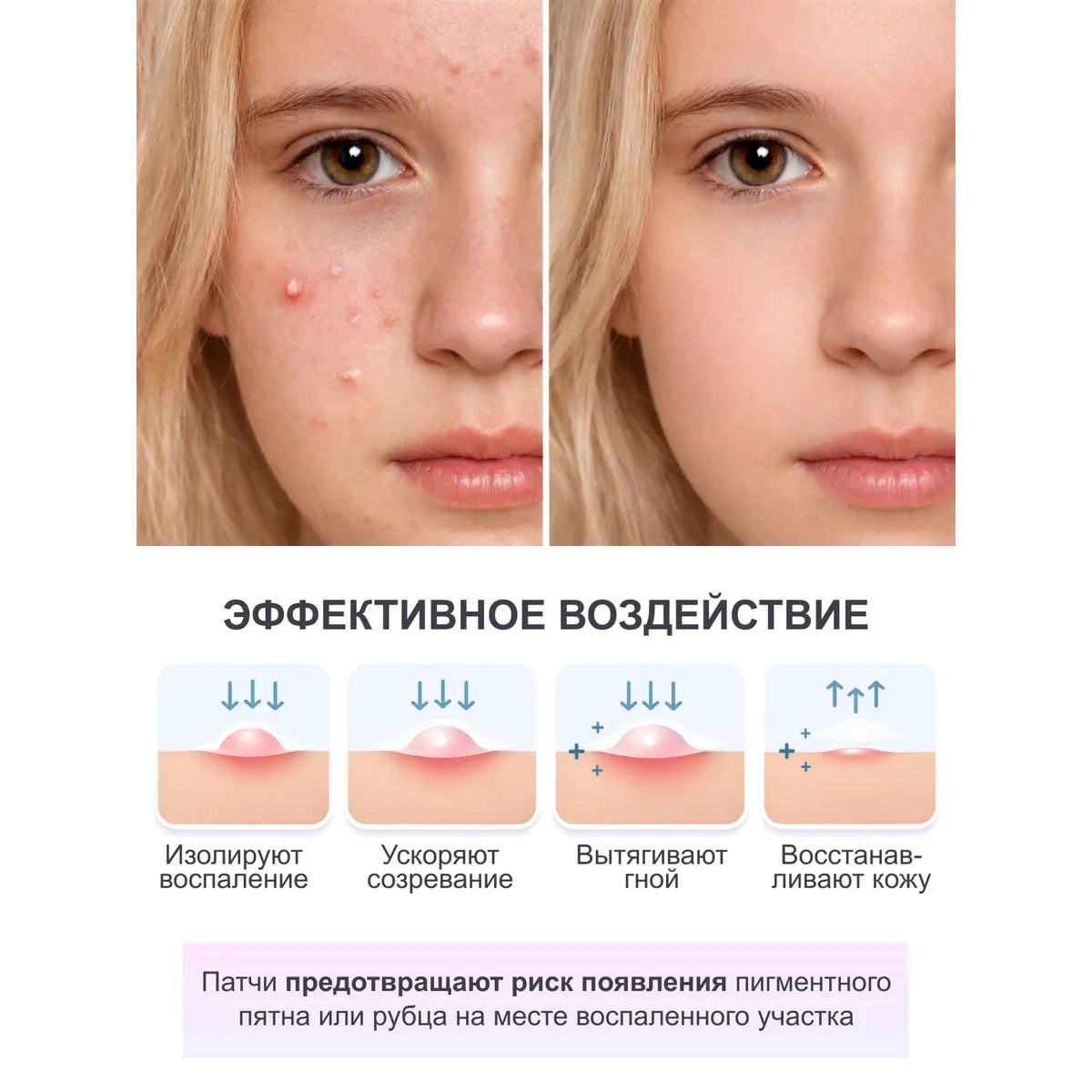 Патчи от прыщей и акне звездочки