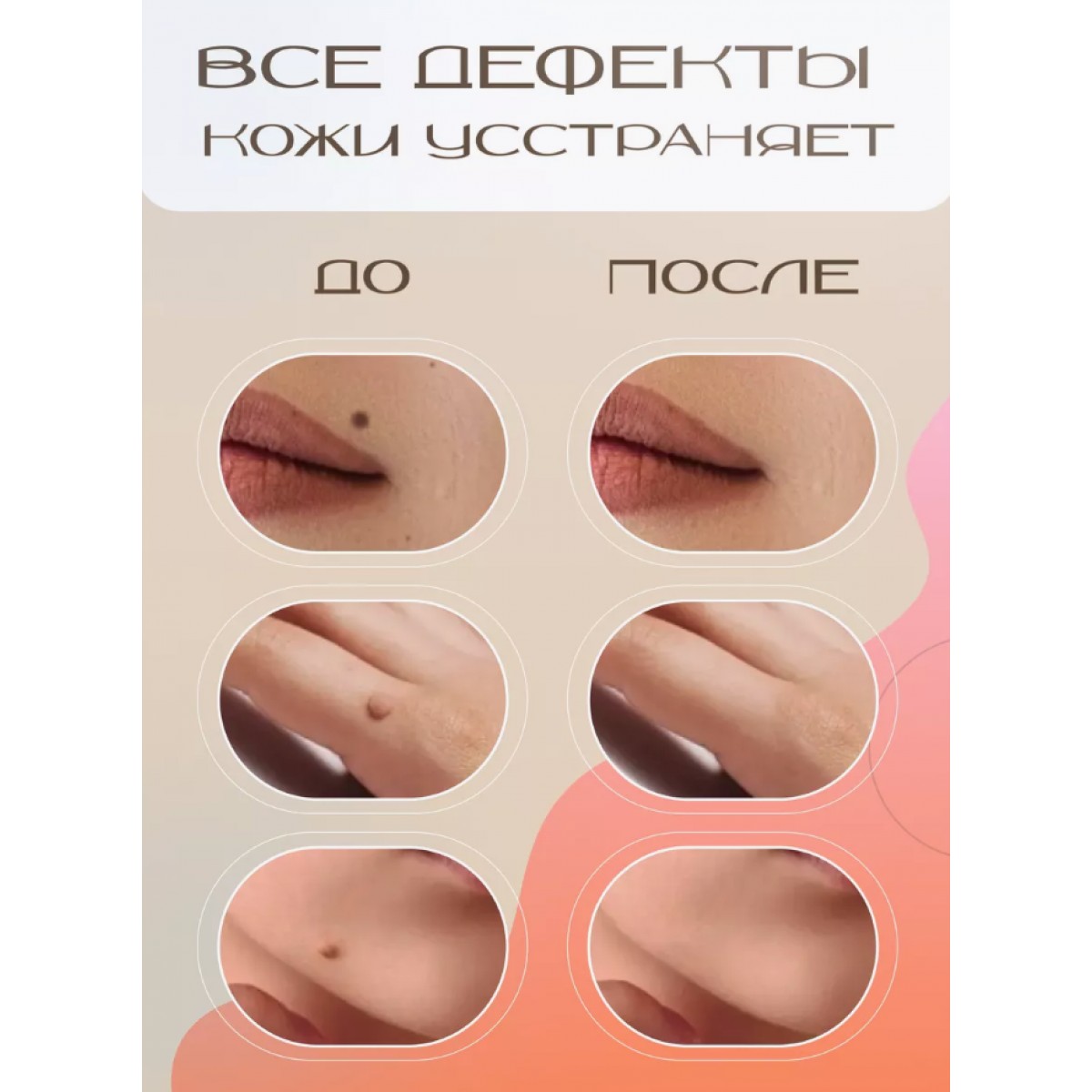 Аппарат для удаления бородавок, папиллом, веснушек